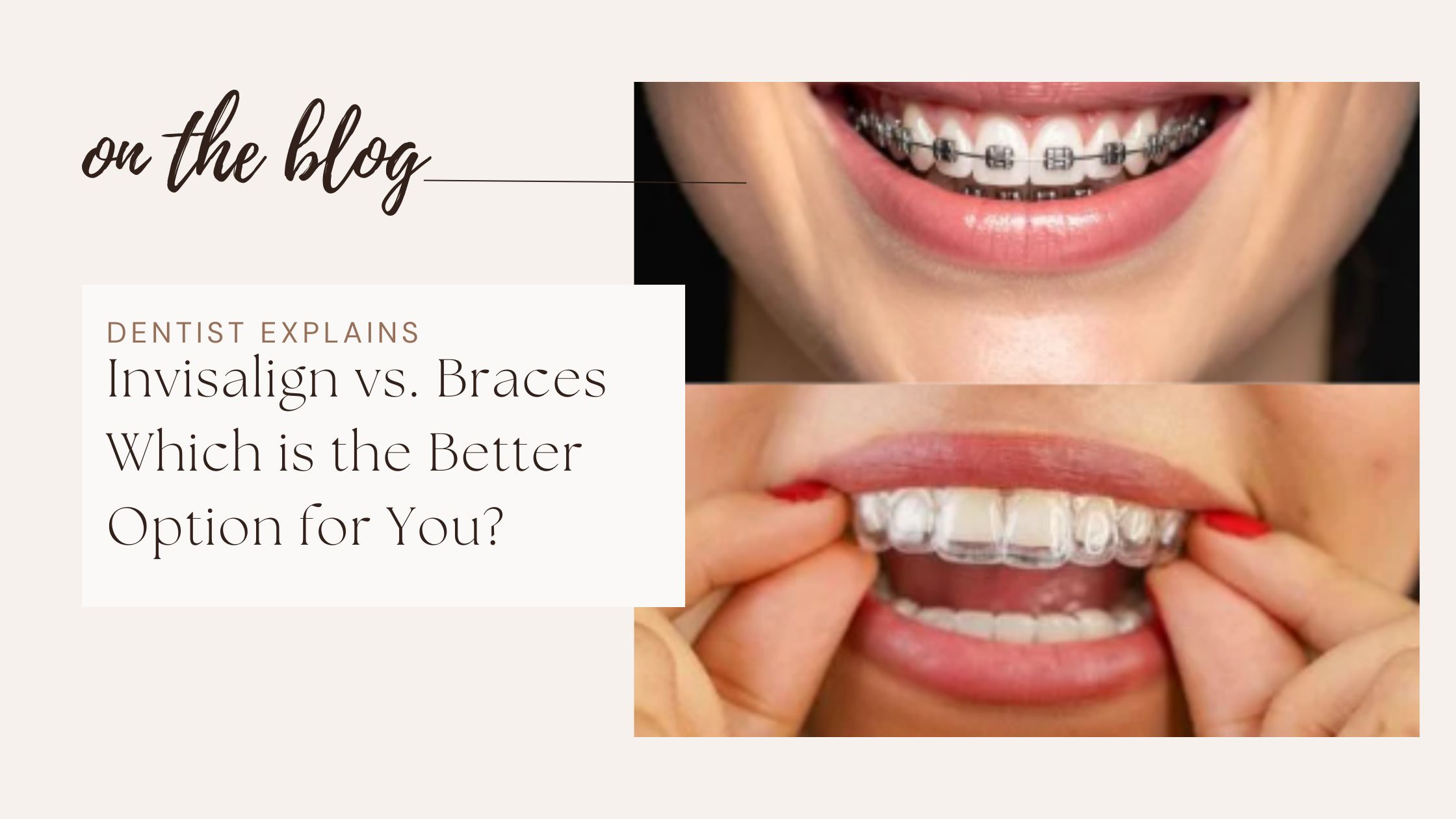 clear view of invasalign and braces