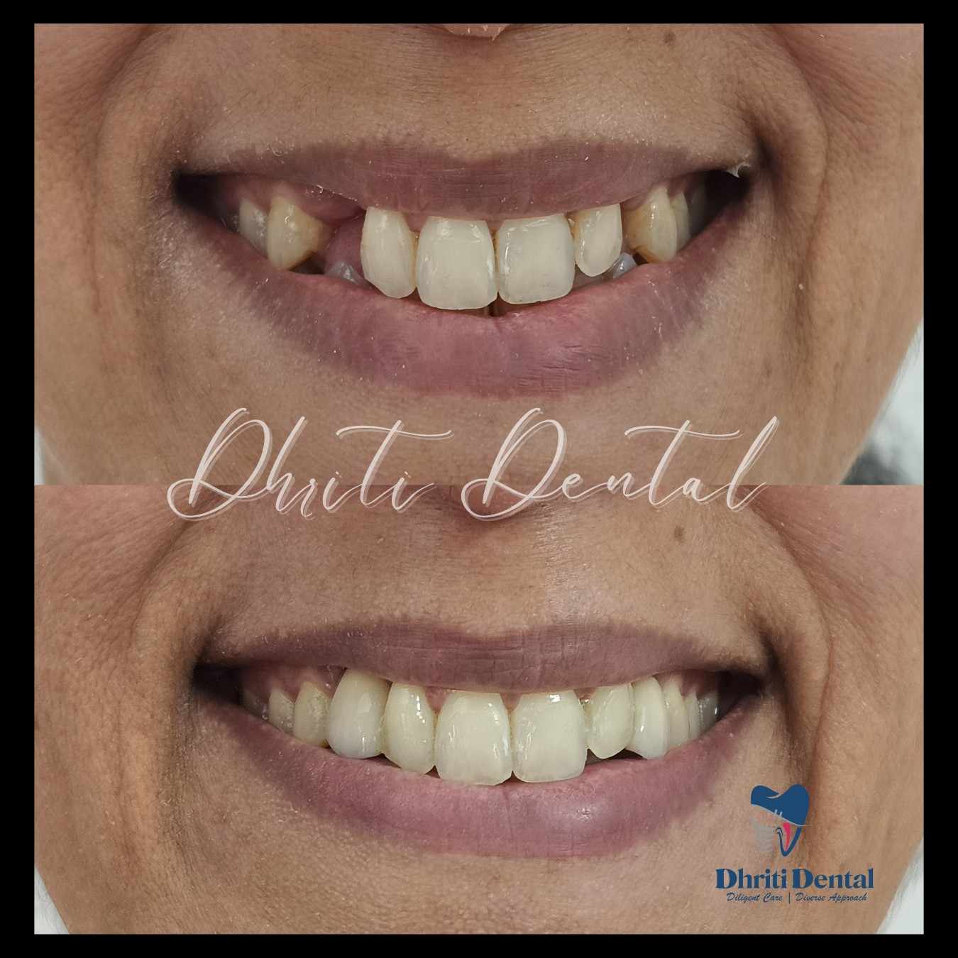 Before and after Missing Teeth treatment showing improved smile.
