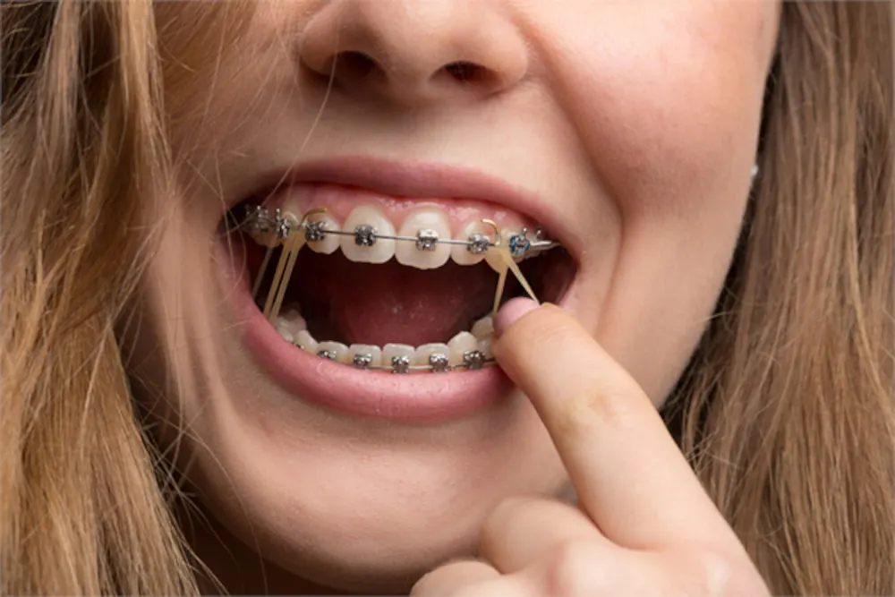 Elastics for Braces
