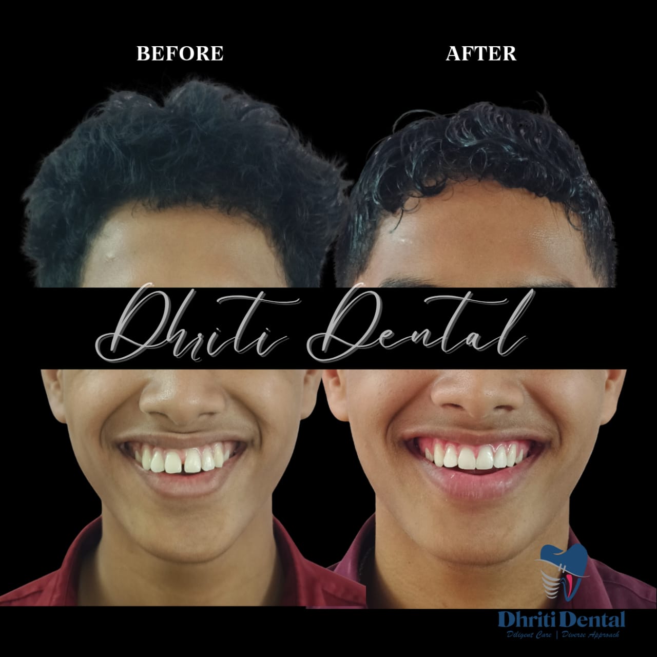 Before and after braces treatment showing straighter teeth.
