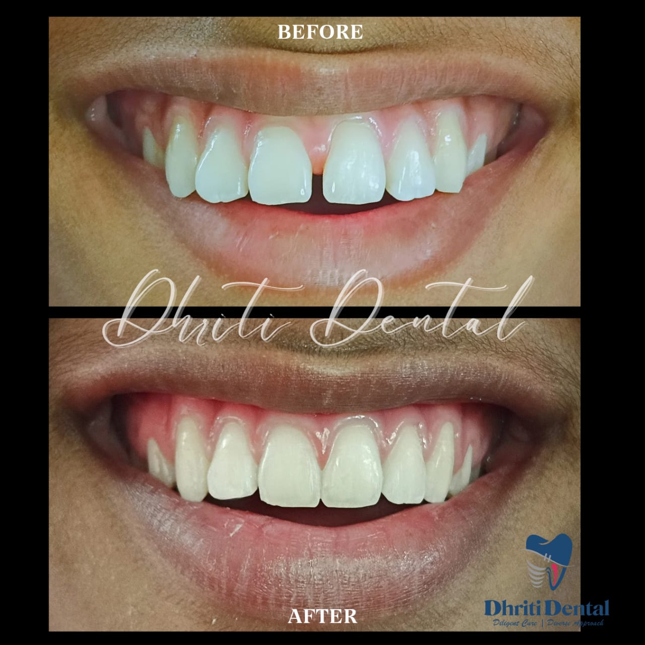 Braces before and after result.