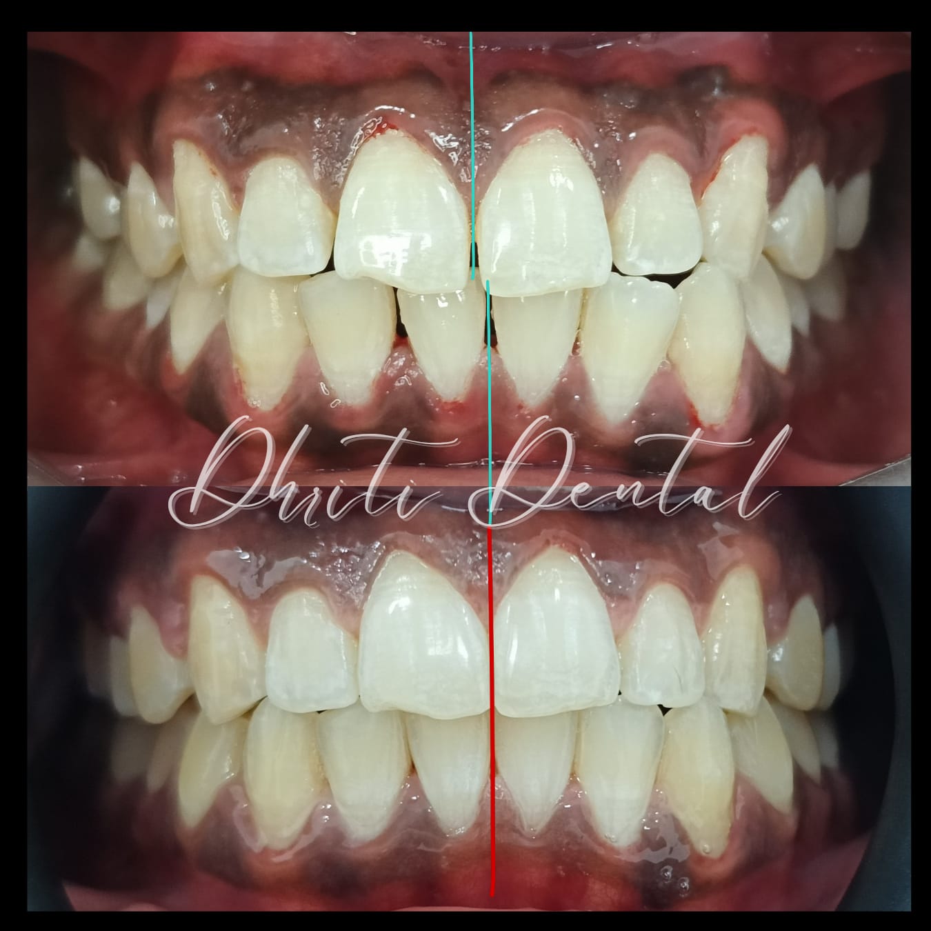 Before and after Invisalign treatment for crowded teeth.