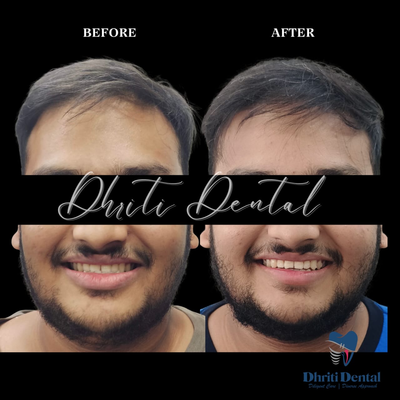 Before-after view of invasalign.