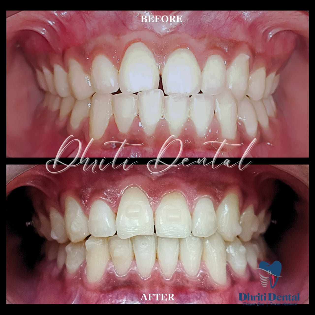 Dhriti Dental's before-after view of invasalign.