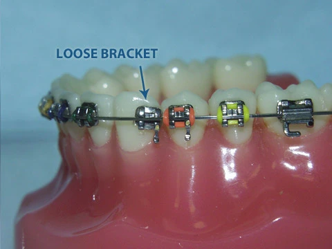 loose bracket