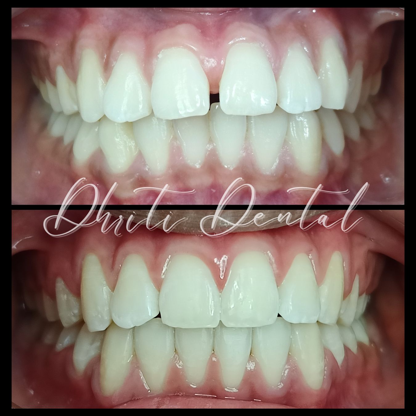 Before and after braces treatment showing gap closure between teeth.